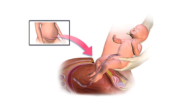 Laparoscopy